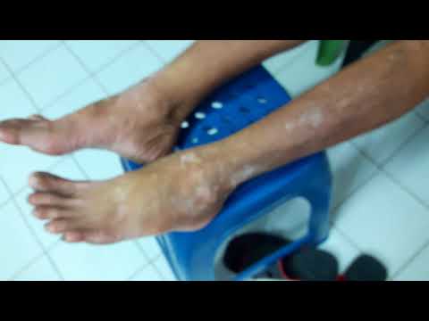 Krymu โรคสะเก็ดเงิน โรคสะเก็ดเงิน Biol