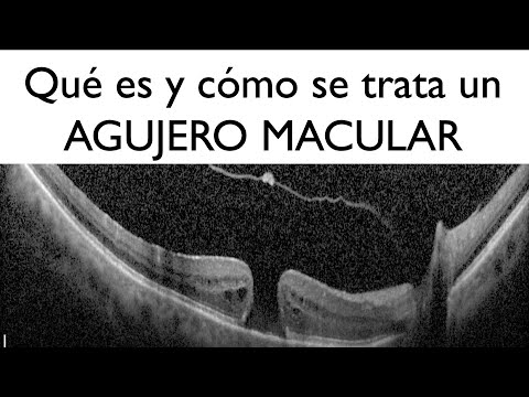 What is a macular hole and how is it treated? - Dr. Gerardo García Aguirre - Retina