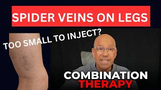 The New Gold Standard for Leg Spider Veins? Sclerotherapy vs. RF Thermocoagulation