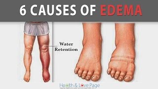 6 Causes of Edema Water Retention