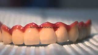 preview picture of video 'Hybrid denture for dental implant supported bridge!!'