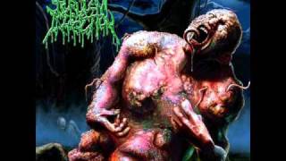 Purulent Infection - Dissected