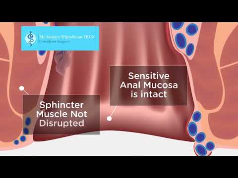 Laser Haemorrhoid Surgery