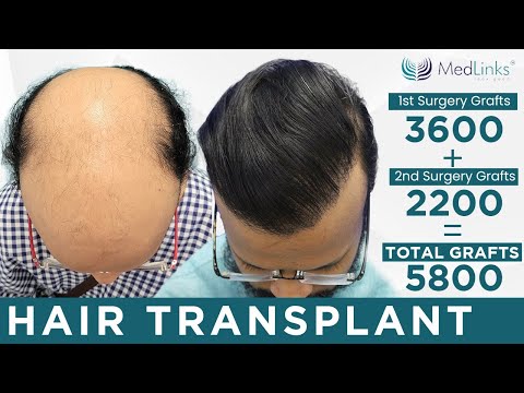 💥Best Hair Transplant Results in Delhi, India | Best...