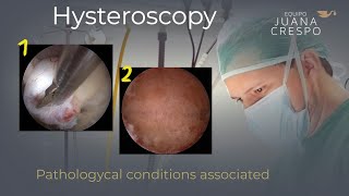 Hysteroscopic solution (Myoma & Adenomyoma)