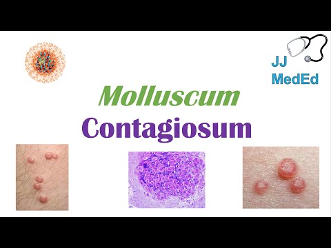 Molluscum Contagiosum (“Papules with Belly Buttons”): Risk factors, Symptoms, Diagnosis,  Treatment