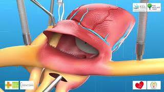 World's First Modified Senning's Operation 3D Medical Animation