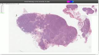 Histopathology - Toxoplasma Lymphadenitis
