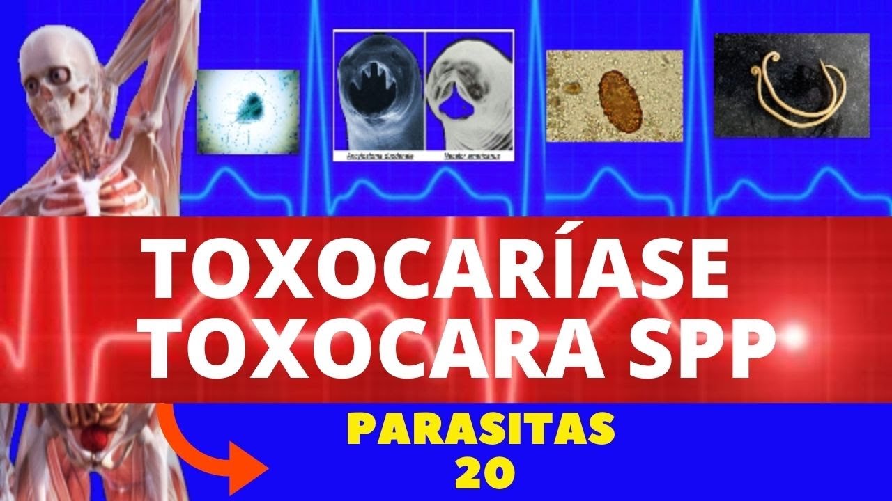 TOXOCARÍASE - TOXOCARA CANIS (LARVA MIGRANS VISCERAL) - PARASITOLOGIA| INFECTOLOGIA