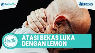 Tips Atasi Bekas Luka dengan Bahan Alami Hanya di Rumah, dari Kandungan Lidah Buaya hingga Lemon