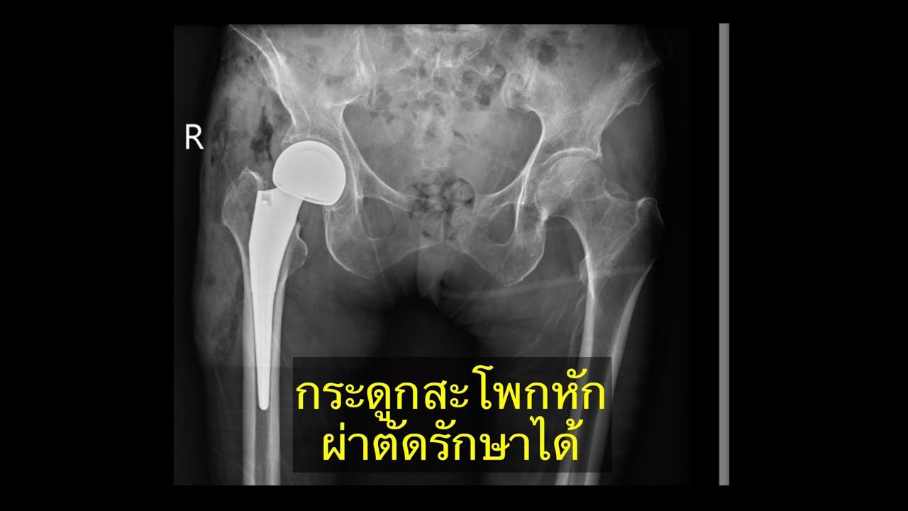กระดูกสะโพกหักผ่าตัดรักษาได้ : ด้วยเทคนิคการผ่าตัดเปลี่ยนข้อสะโพกเทียมแบบไม่ตัดกล้ามเนื้อ