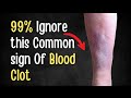 Most People Ignore These Common Signs Of A Blood Clot