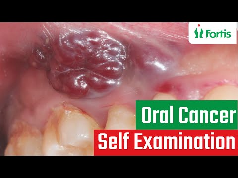 Self-examination for Prevention of Oral Cancer