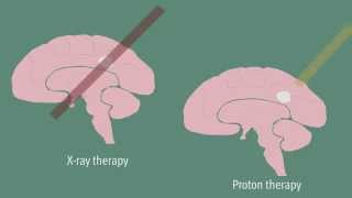 Particle Beam Therapy