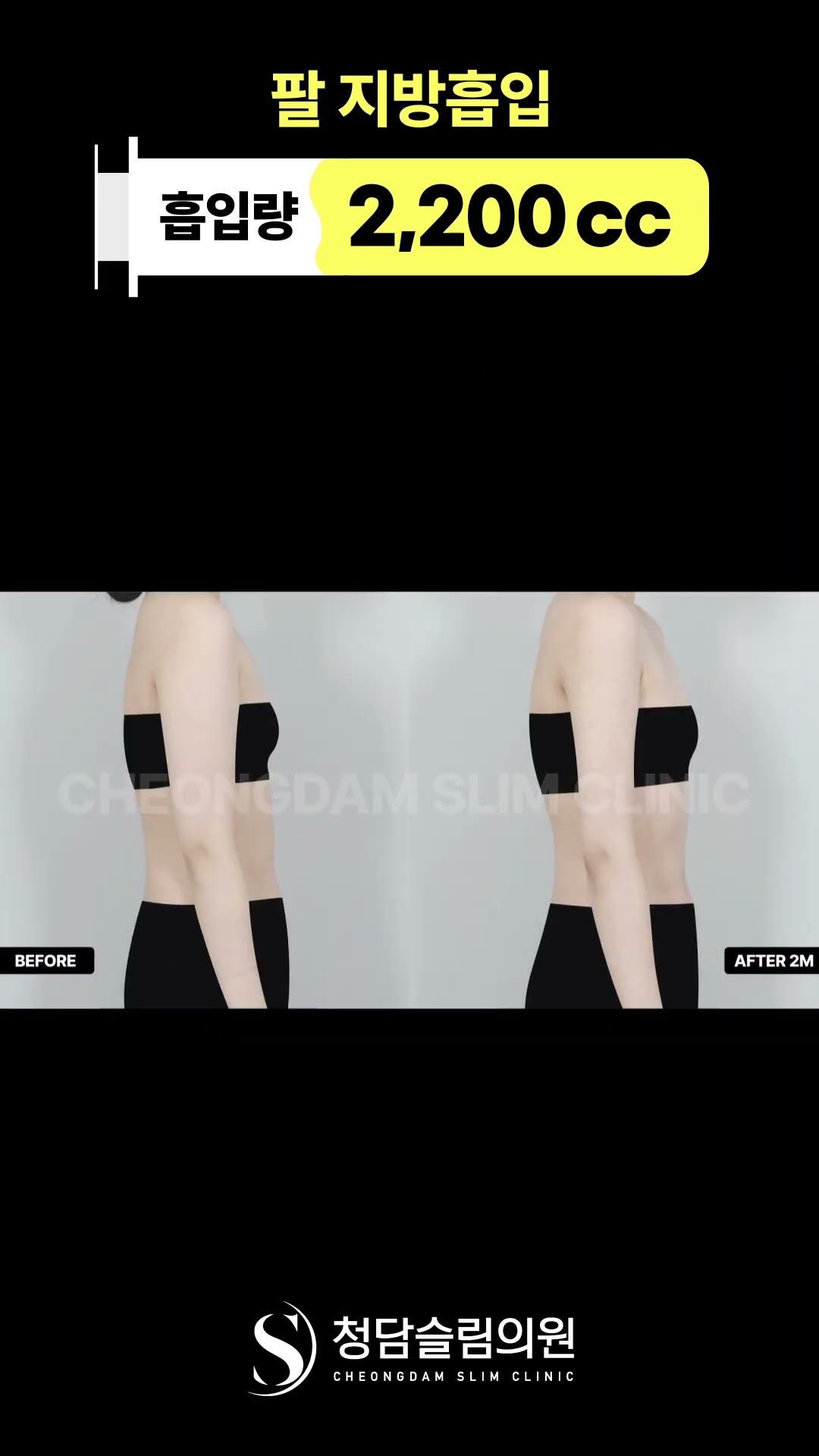 긴팔 속에 숨어도 티 나는 뼈팔