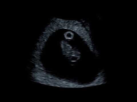 What Can You See At An 8 Week Baby Scan?