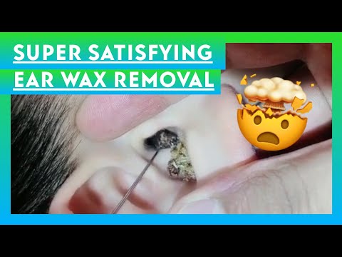 Super Satisfying Ear Wax Removal