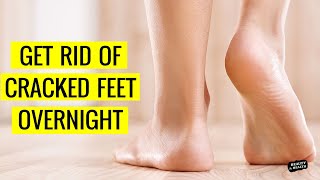 How to Get Rid of Dry Cracked Feet Overnight | Heal Cracked Heels Fast
