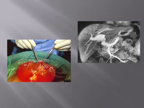 Fliegen in einem Flugzeug hypertensive Diagnostizierten hypertensive Angiopathie