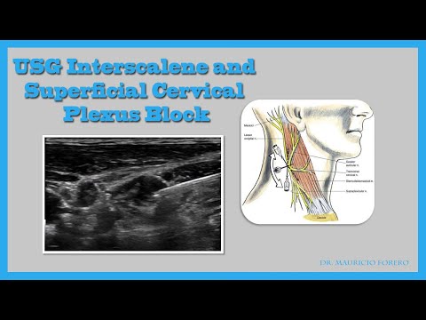 USG Interscalene and Superficial Cervical Plexus Block