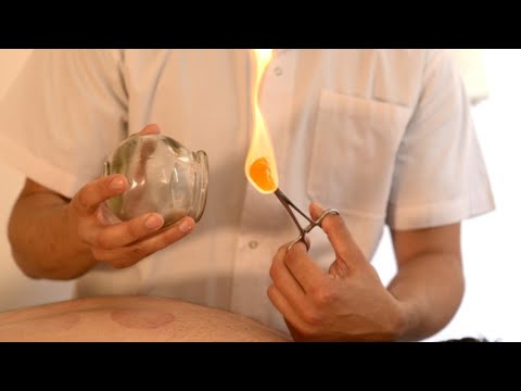How To Do Fire Cupping