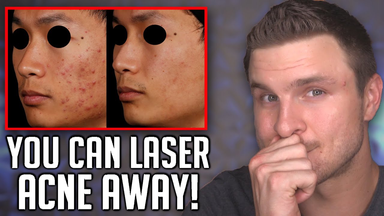 New Treatment DESTROYS Acne Glands! (Aviclear)