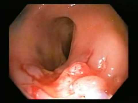 codice icd 9 per resezione transuretrale della prostata