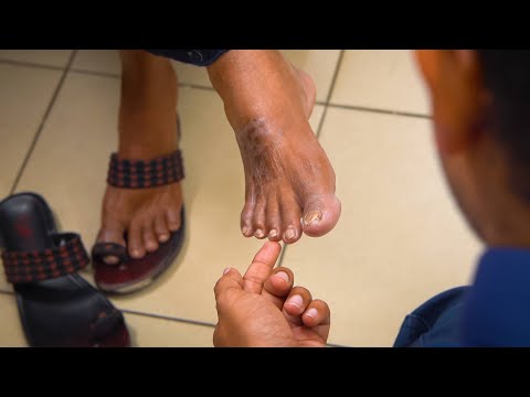 The Diabetic Foot Exam - Video - Global Health Media Project
