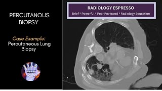 PERCUTANEOUS BIOPSY: Case Example – Percutaneous Lung Biopsy