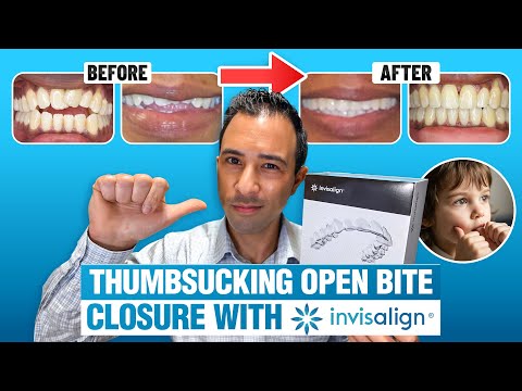 How Invisalign Fixes Thumbsucking Open Bite | Invisalign Expert Doctor | Real Patient Transformation