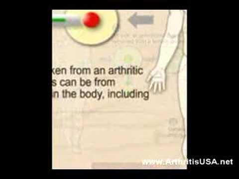 Applications of Stem Cells in Arthritis