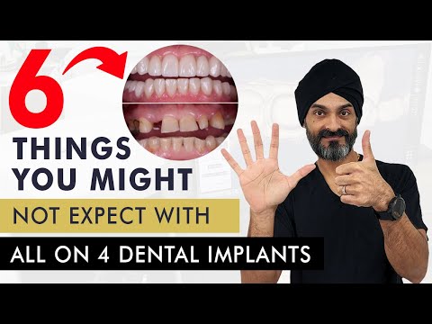 6 Things You Might Not Expect With All on 4 Dental Implants or a full mouth of dental implants