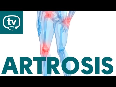 Algunos datos clave sobre la artrosis