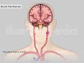 Cerebral Embolism Caused By Atrial Fibrillation In Heart