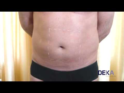 Onda Coolwaves - Body Contouring mit Microwellen - Fettreduktion