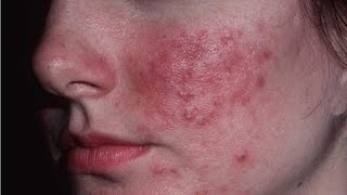 Home Remedies for rosacea | Red Face | How to get rid of Rosacea