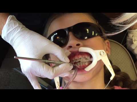 GABRIELLE GETS BRACES | EPISODE 12 Video