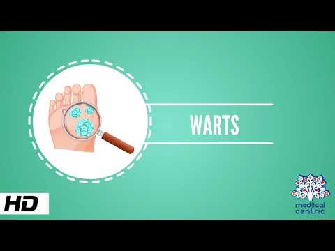 Wart, Causes, Signs and Symptoms, Causes, Diagnosis and Treatment.