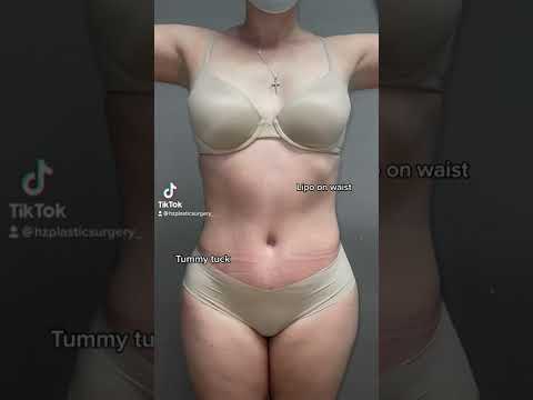 Tummy Tuck + Liposuction On Waist By Dr. Z At 3 Months Post-Op 🔥