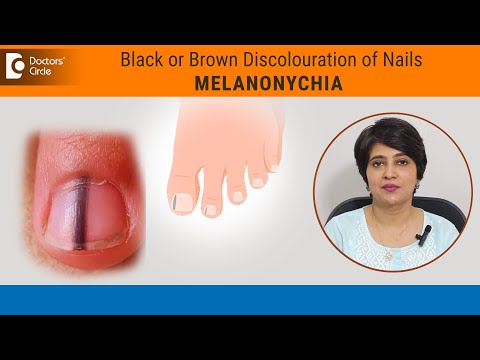 Black lines in nails| Streaks on Nail|Melanonychia Causes & Treatment-Dr.Rasya Dixit|Doctors' Circle