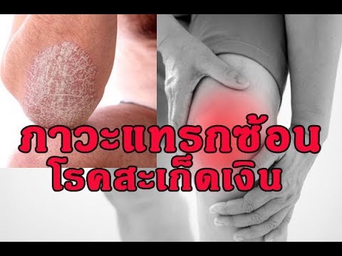คุณสามารถรักษากลากจาระบี อาบน้ำที่มีโรคสะเก็ดเงินตำแย
