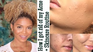 How I got rid of my acne + Holy grail skincare routine | MakeupbyDenise