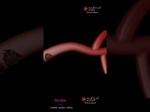 Ischemic Stroke By A Blood Clot | CVA | Cerebral Vascular Accident | Animation