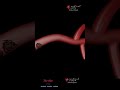 Ischemic Stroke By A Blood Clot CVA Cerebral Vascular Accident Animation