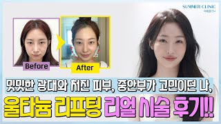 울쎄라 + 티타늄 리얼 시술 후기