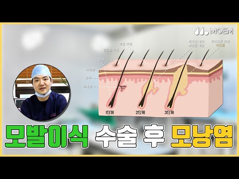 모발이식 수술 후 발생하는 모낭염이란? 전지훈 원장ㅣ모엠의원(MOEM)ㅣ히든컷