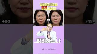 딥플레인 안면거상술 성형 시술