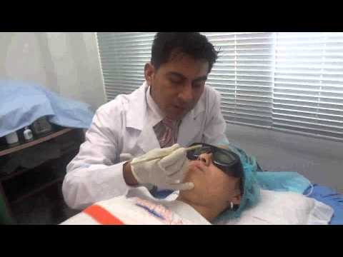 Eliminar pecas en la cara, borrar pecas en el rostro – Tratamiento Facial en Lima Perú