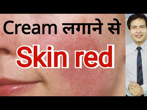 The skin turned red after applying the cream.