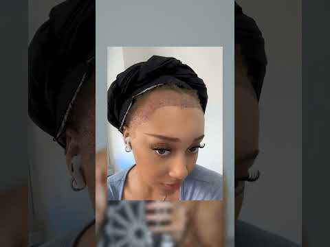 She Got Surgery To Shrink Her Forhead 😲